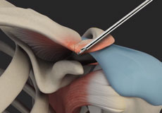 AC Joint Stabilisation