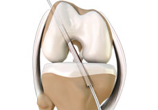 ACL Reconstruction