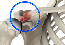 Acromioclavicular (AC) Joint Osteoarthritis