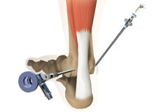 Ankle Arthroscopy