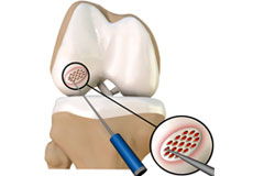 Arthroscopic Debridement