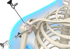 Arthroscopic Frozen Shoulder Release