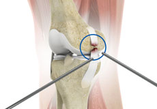 Arthroscopic Reconstruction of the Knee for Ligament Injuries