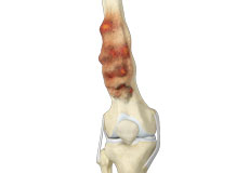 Benign Bone Lesion Treatment