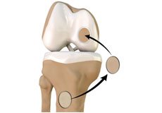 Chondroplasty