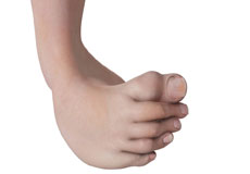 Congenital Limb Deformities