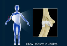 Pediatric Fractures