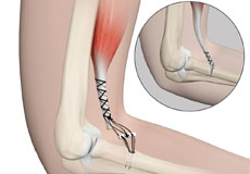 Elbow Tendon and Ligament Repair