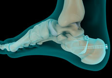 Internal and External Fixation of Foot and Ankle Fractures