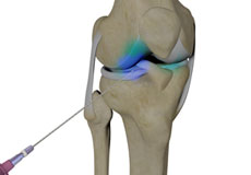 Intraarticluar Knee Injection