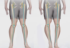 Knee Angular Deformities