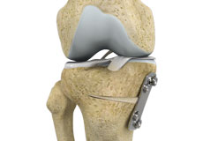 Knee Osteotomy