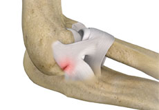 Lateral Ulnar Collateral Ligament Injuries (Elbow)