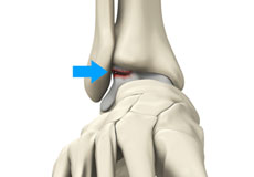 Osteochondral Injuries of the Ankle