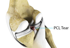 PCL Injuries