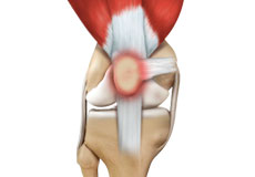 Runner's Knee