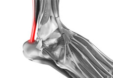 Tendinopathies